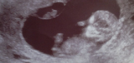 Tweelinghelft in baarmoeder